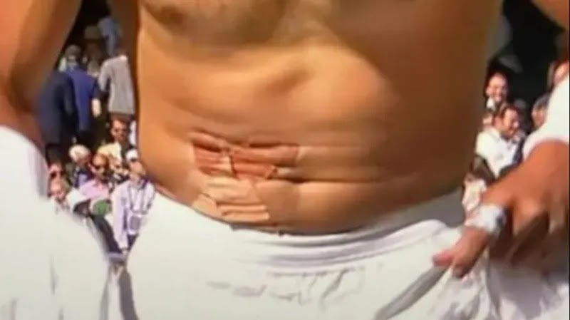 Close up of the patch on Nadal’s stomach.